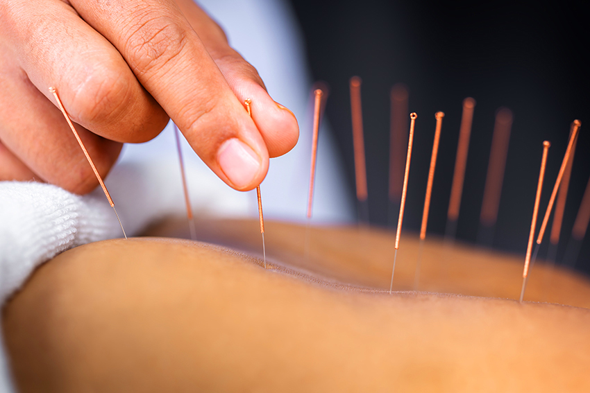 Acupuncture Pain Relief Meridian Balancing Therapy Steuben, Oneida County, NY