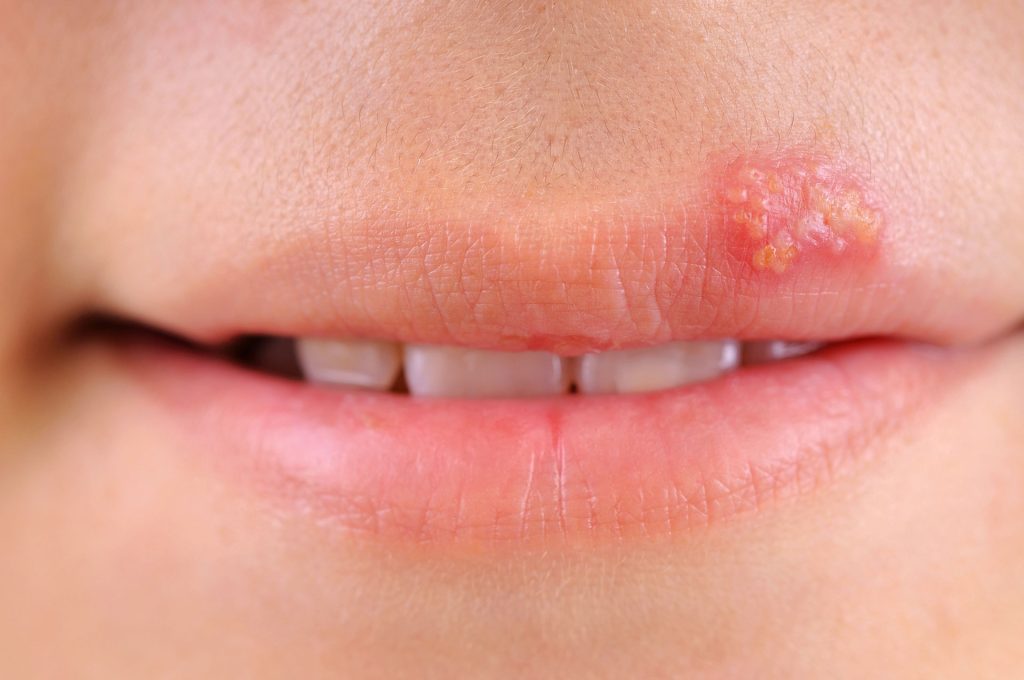Understanding Herpes Simplex Virus: Prevalence, Impact, and Immune Response